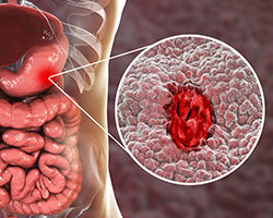 Location of a peptic ulcer in the gastrointestinal tract