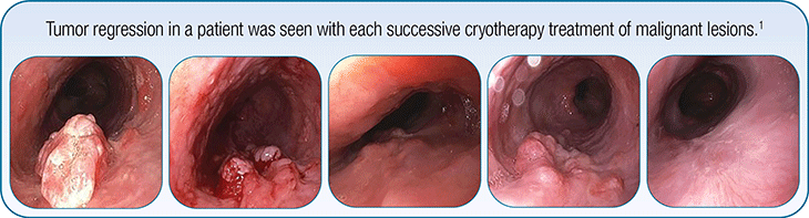 Tumor regression post-spray cryotherapy treatment