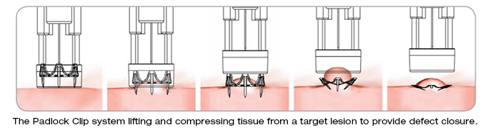 The Padlock Clip system lifting and compressing tissue from a target lesion to provide defect closure.