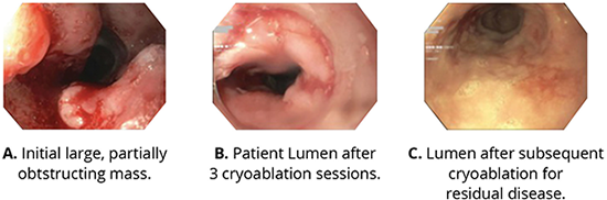 Cryotherapy ESCC Patinet's Clinical Images