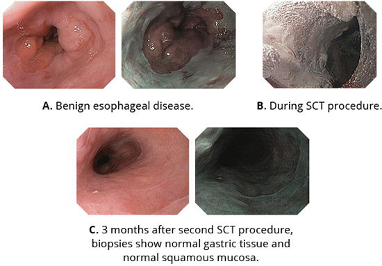 Benign Esophageal Disease.