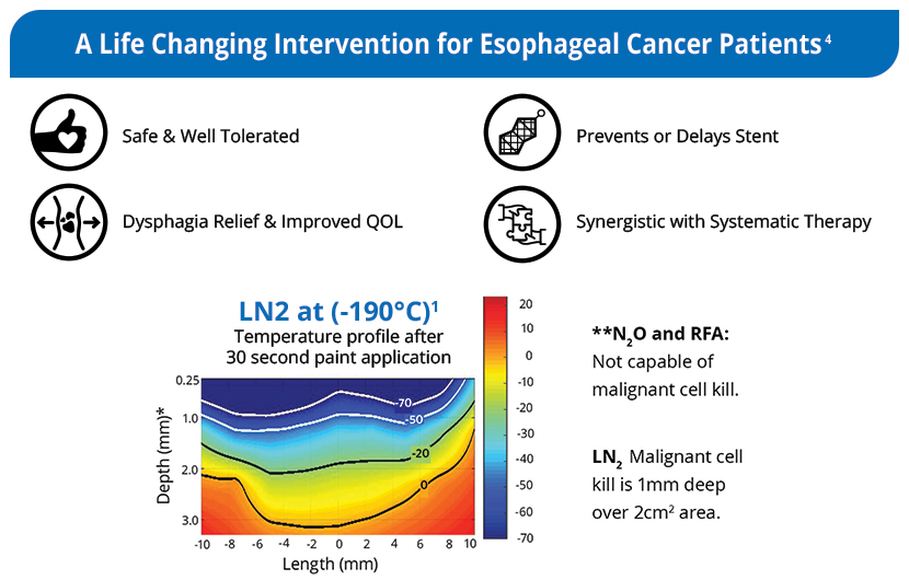 Cryotherapy - A life changing intervention for esophageal cancer patients