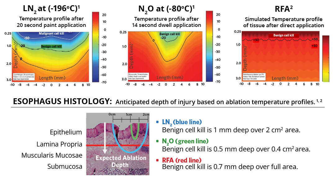 Esophagus Histology: Anticipated depth of injury based on ablation temperature profiles.