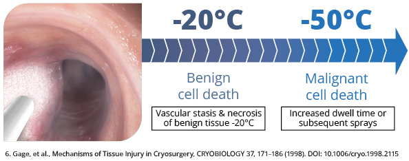 -20 degrees C Benign cell death and -50 degrees C malignant cell death