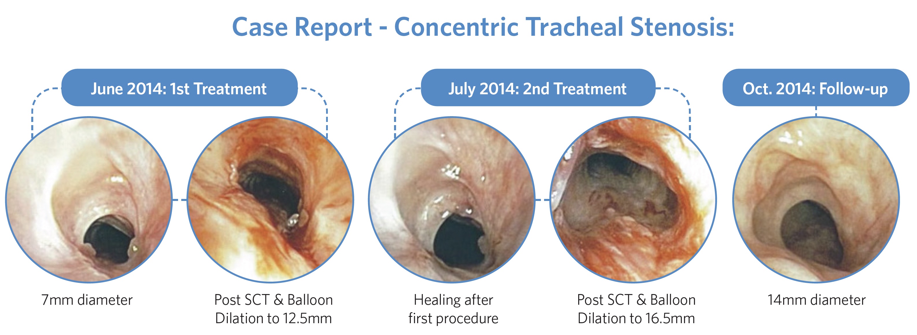 Case Report - concentric Tracheal Stenosis